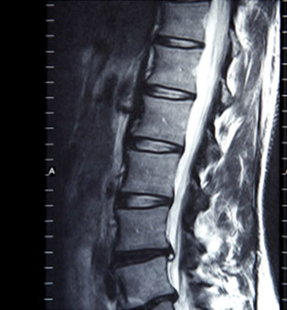 spine-x-ray